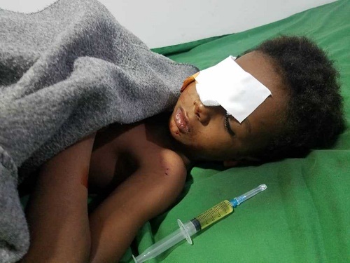 Hodeidah: five children wounded in a houthi bombardment towards displaced camp