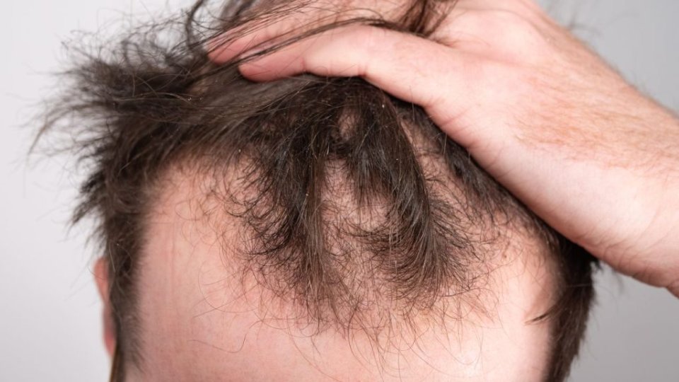 أسباب تساقط الشعر بعيداً عن الوراثة.. علامات تستدعي الانتباه فوراً